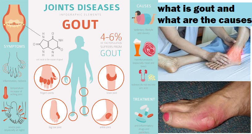 gout